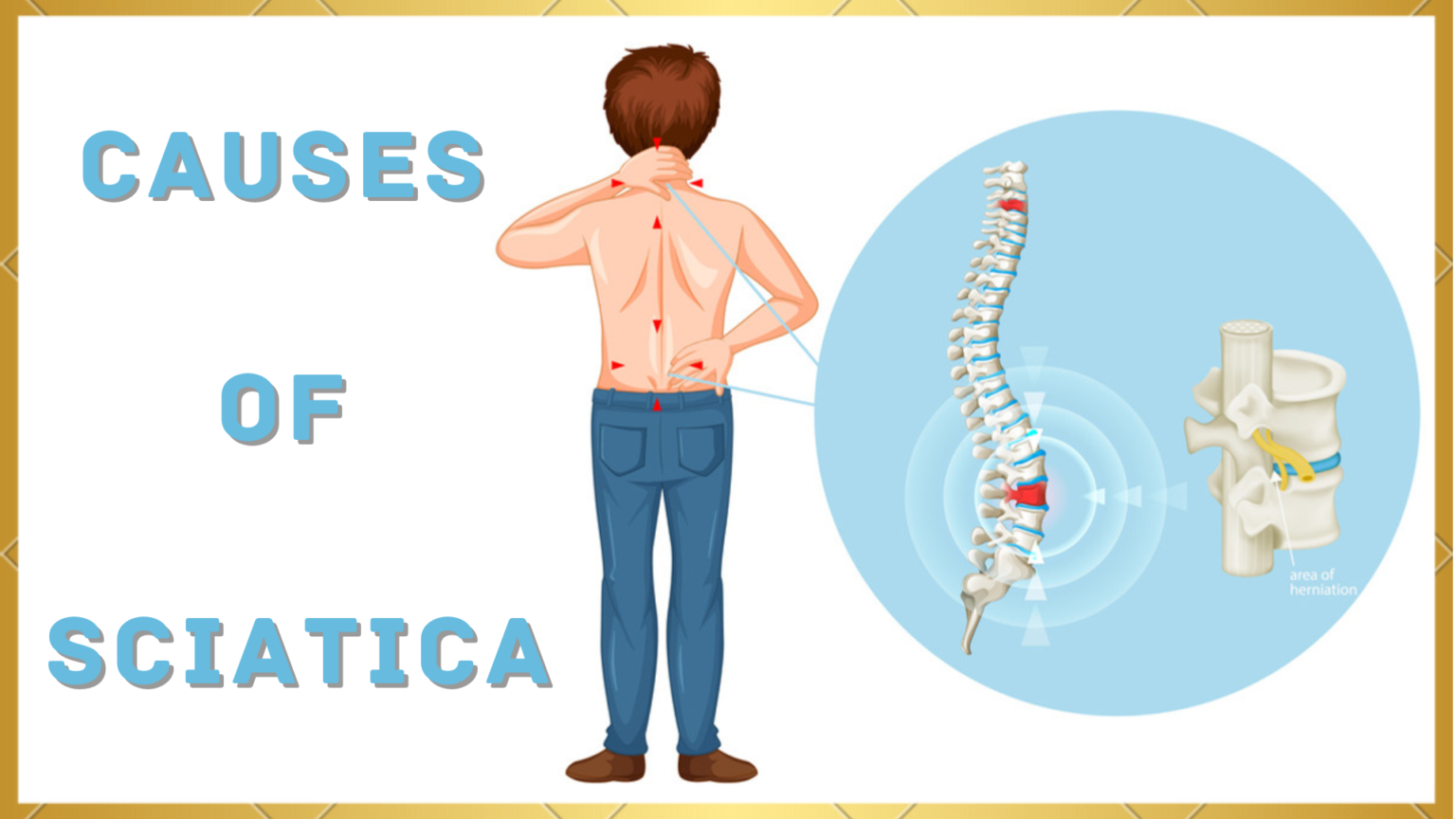 Causes Of Sciatica - Medinutrica